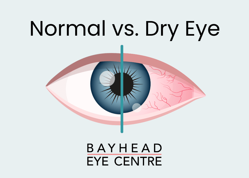 Normal eye vs Dry Eye illustration